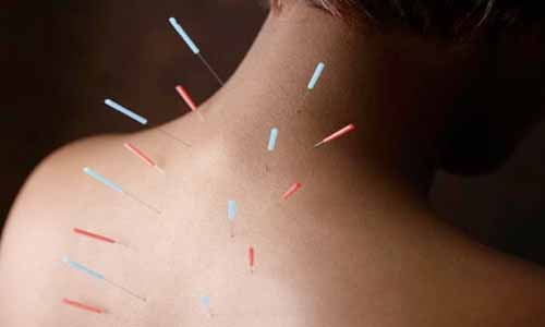 Acupuncture